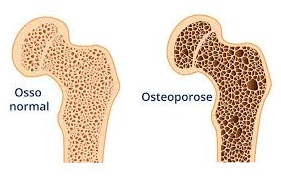 Importância da prevenção da Osteoporose